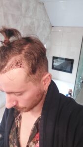 2 weeks post ht after unshaven