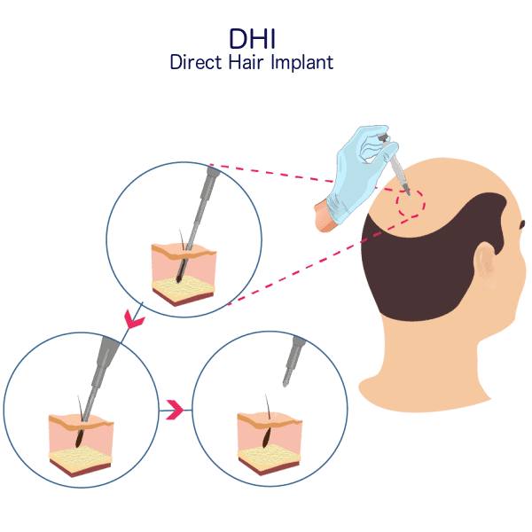 DHI Hair Transplant 1 DHI Hair Transplant Procedure-min