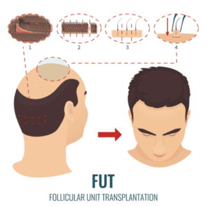 FUT Hair Transplant Procedure-min