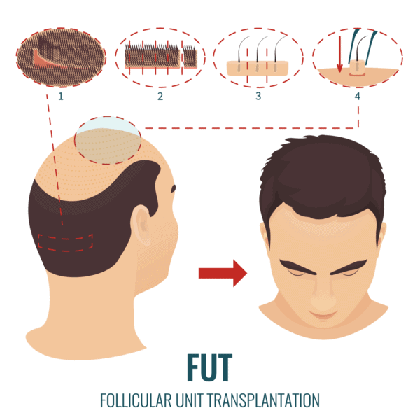 FUT Hair Transplant 1 FUT Hair Transplant Procedure-min