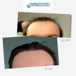 Transgender Hair Transplant Cost Alex trans patient before and after