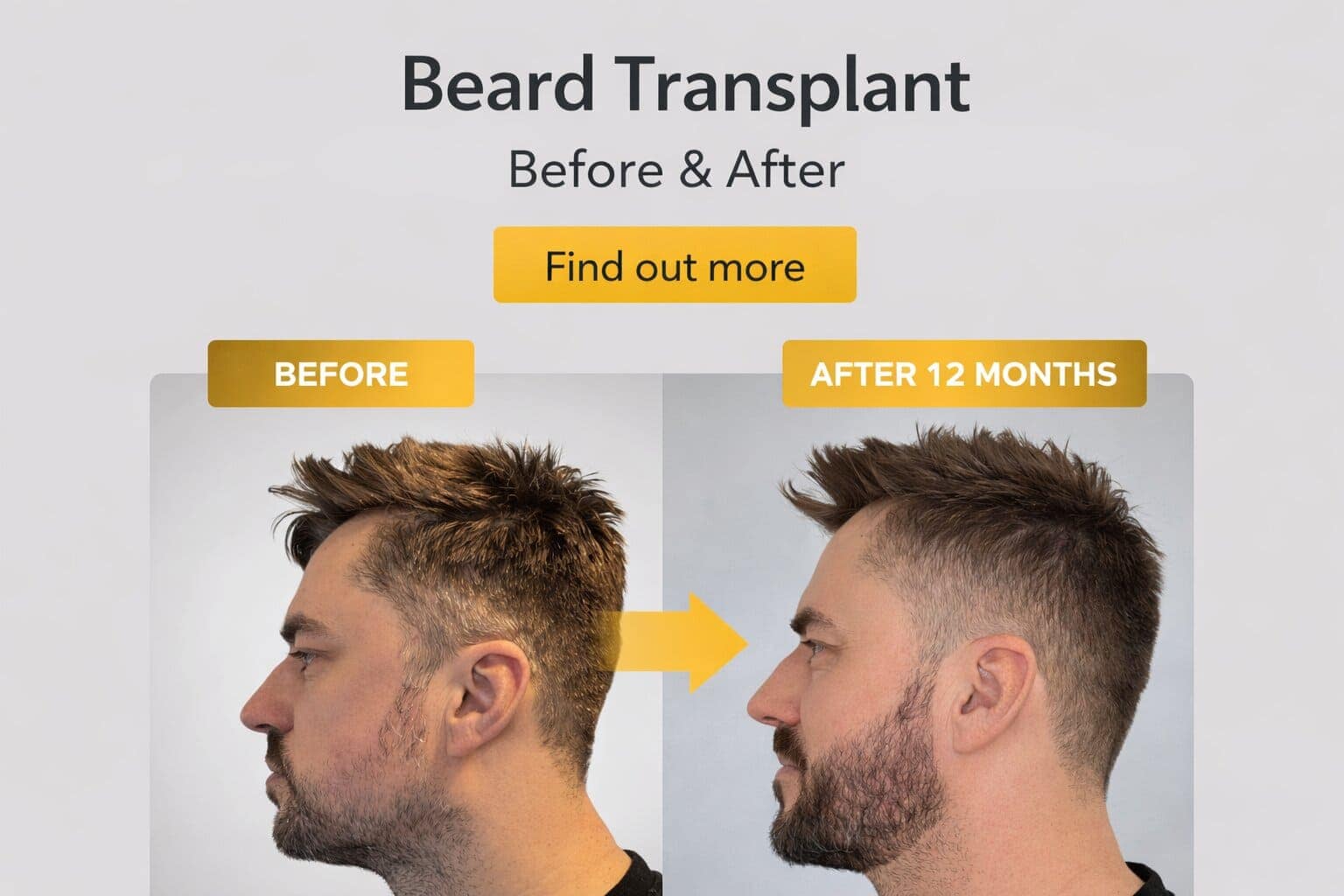Beard Transplants