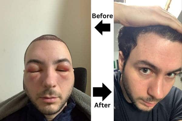 Hair Transplant Swelling Before and after hair transplant swelling