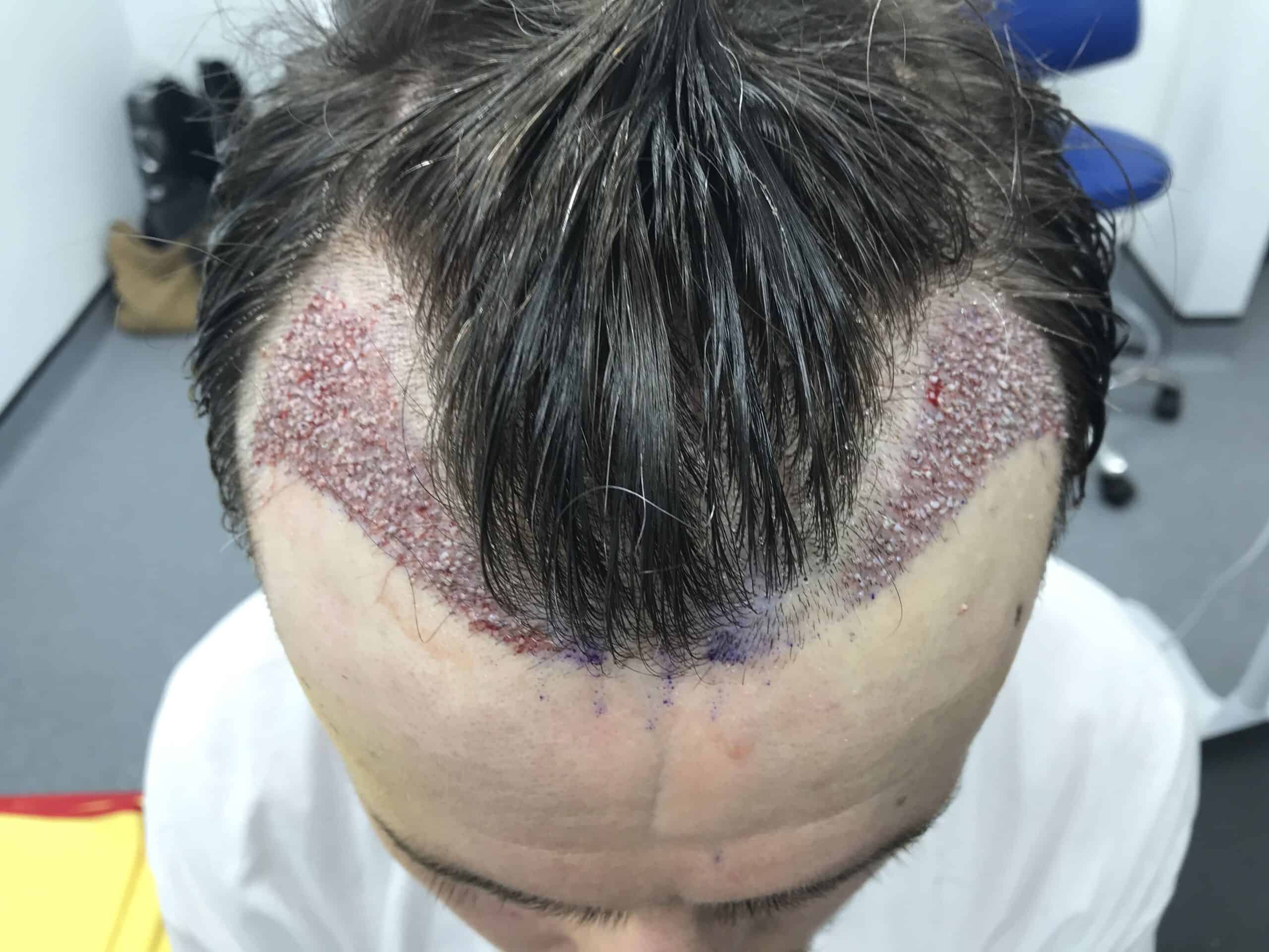 Hair Transplant Without Shaving Billy unshaven hairline hair transplant