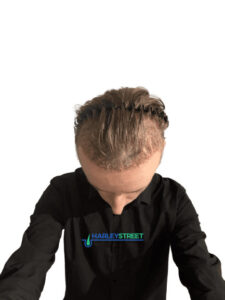 Hair Transplant Timeline Bradin 2 weeks post ht