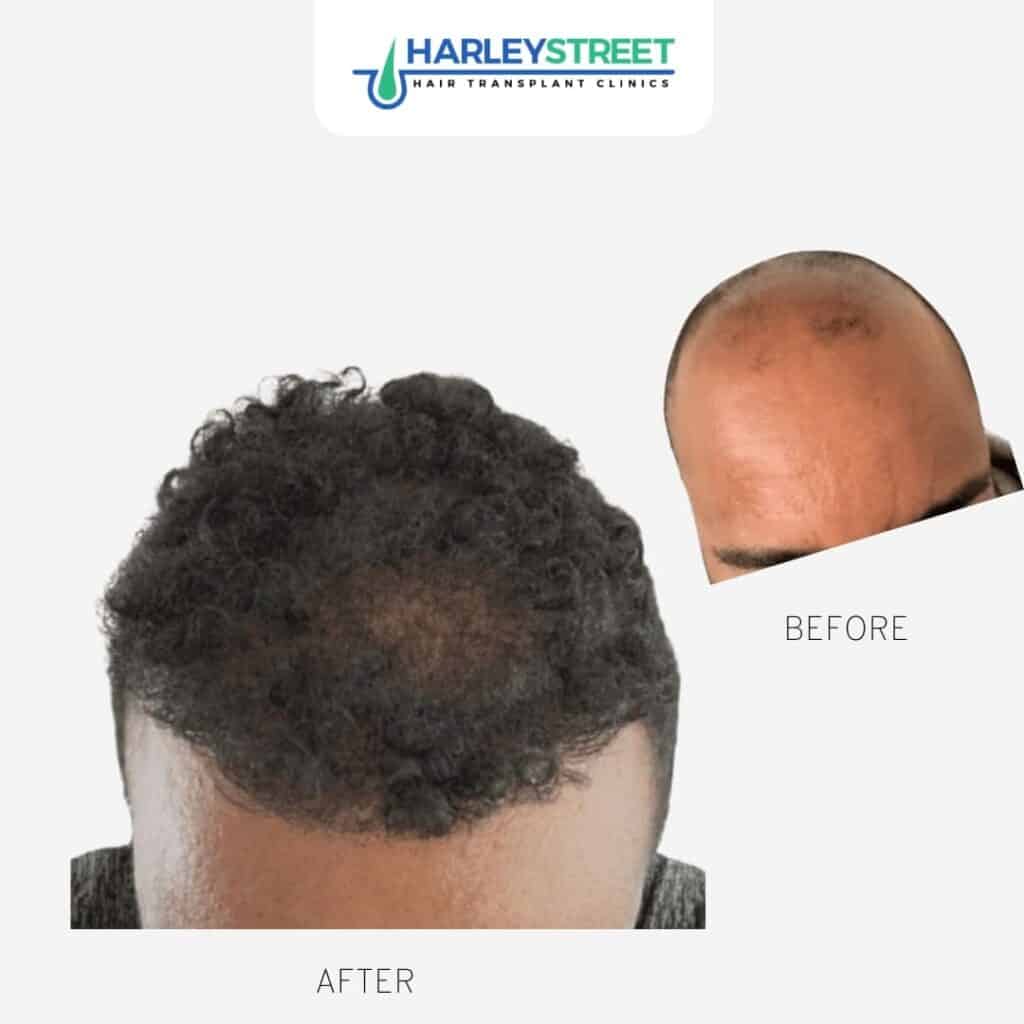 Calvin Before & Afters