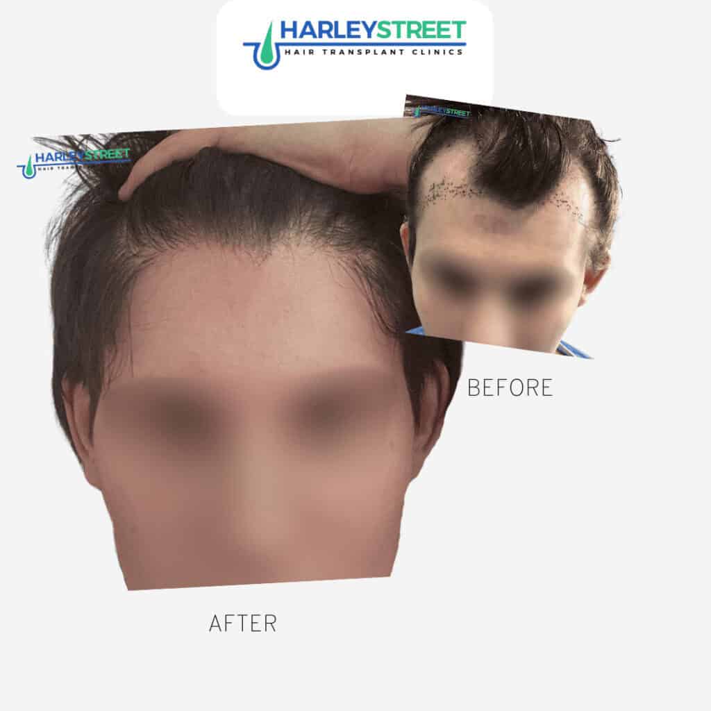 Transgender Hair Transplant Cost Charlotte Lloyd - before and after