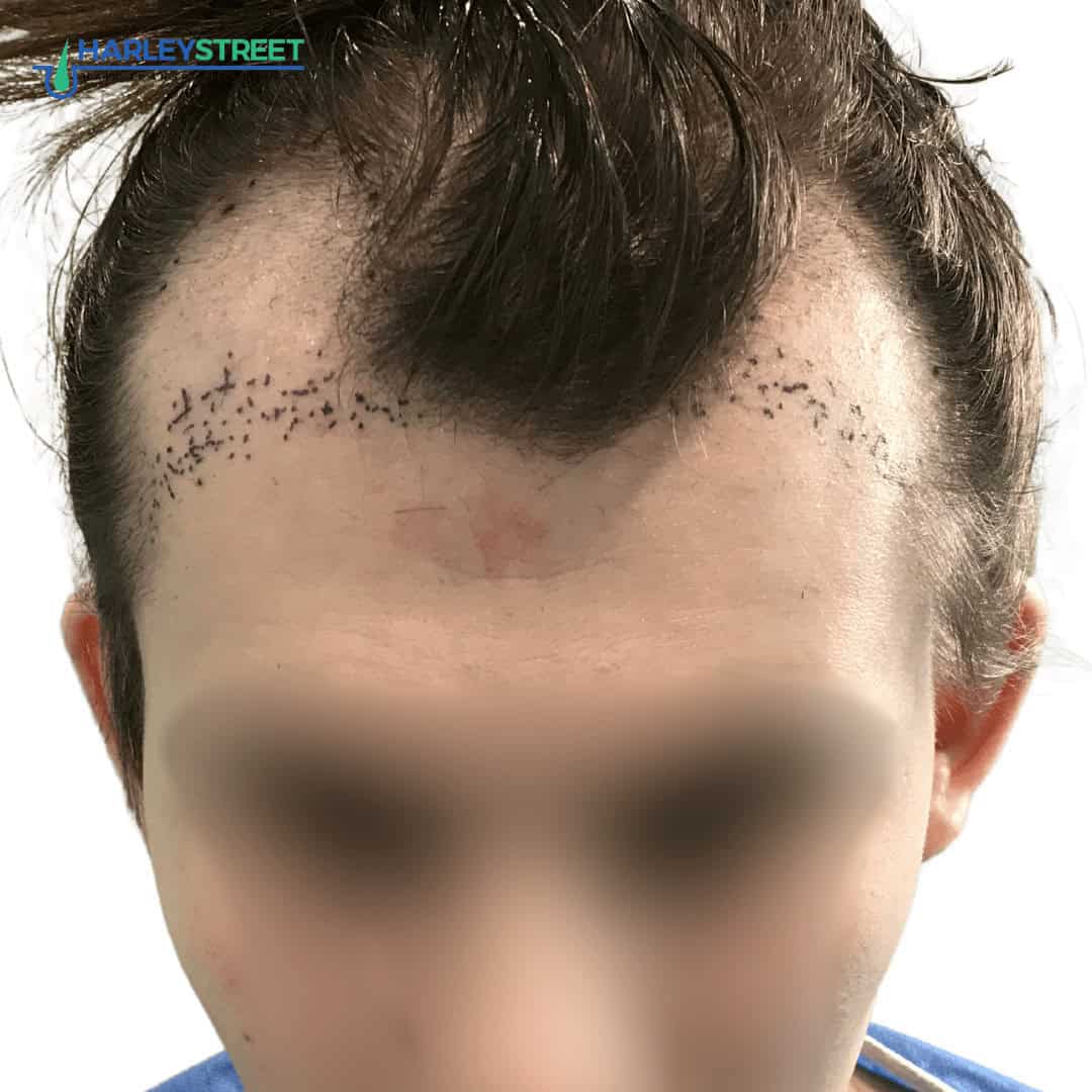 How to Prevent a Receding Hairline & Treatments Charlotte Lloyd pre surgery