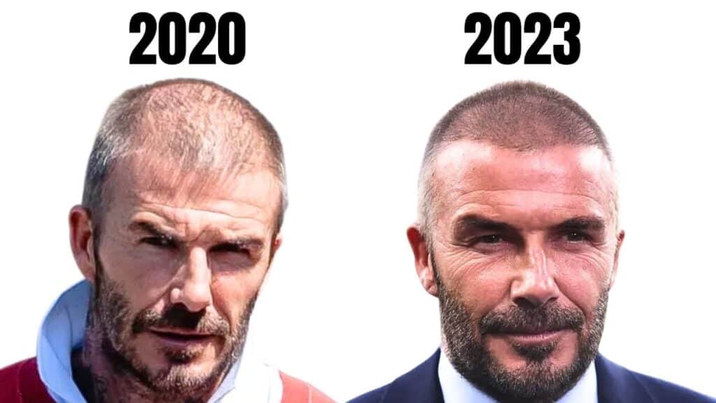 David Beckham Hair Transplant David Beckham before and after hair thinning