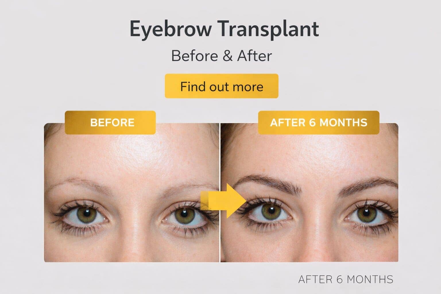 Eyebrow Transplants