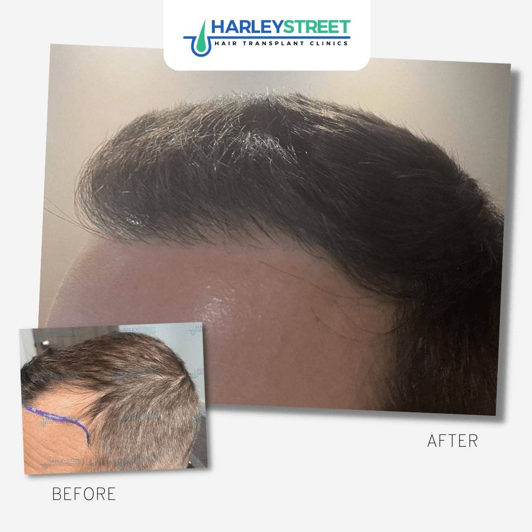 Should I get a hair transplant in Turkey? FUE Before and After 10
