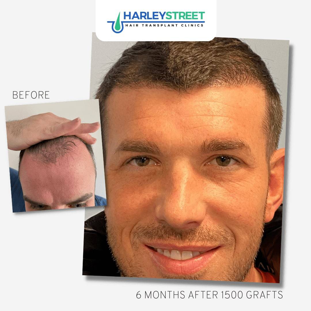 Should I get a hair transplant in Turkey? FUE-Before-and-After-5