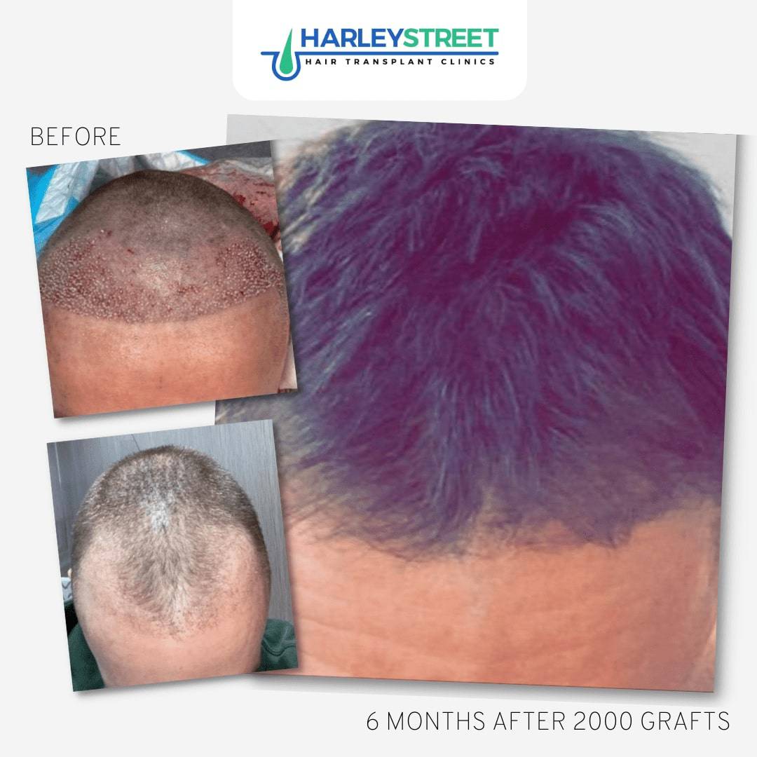 FUE Hair Transplant 3 FUE-Before-and-After-9