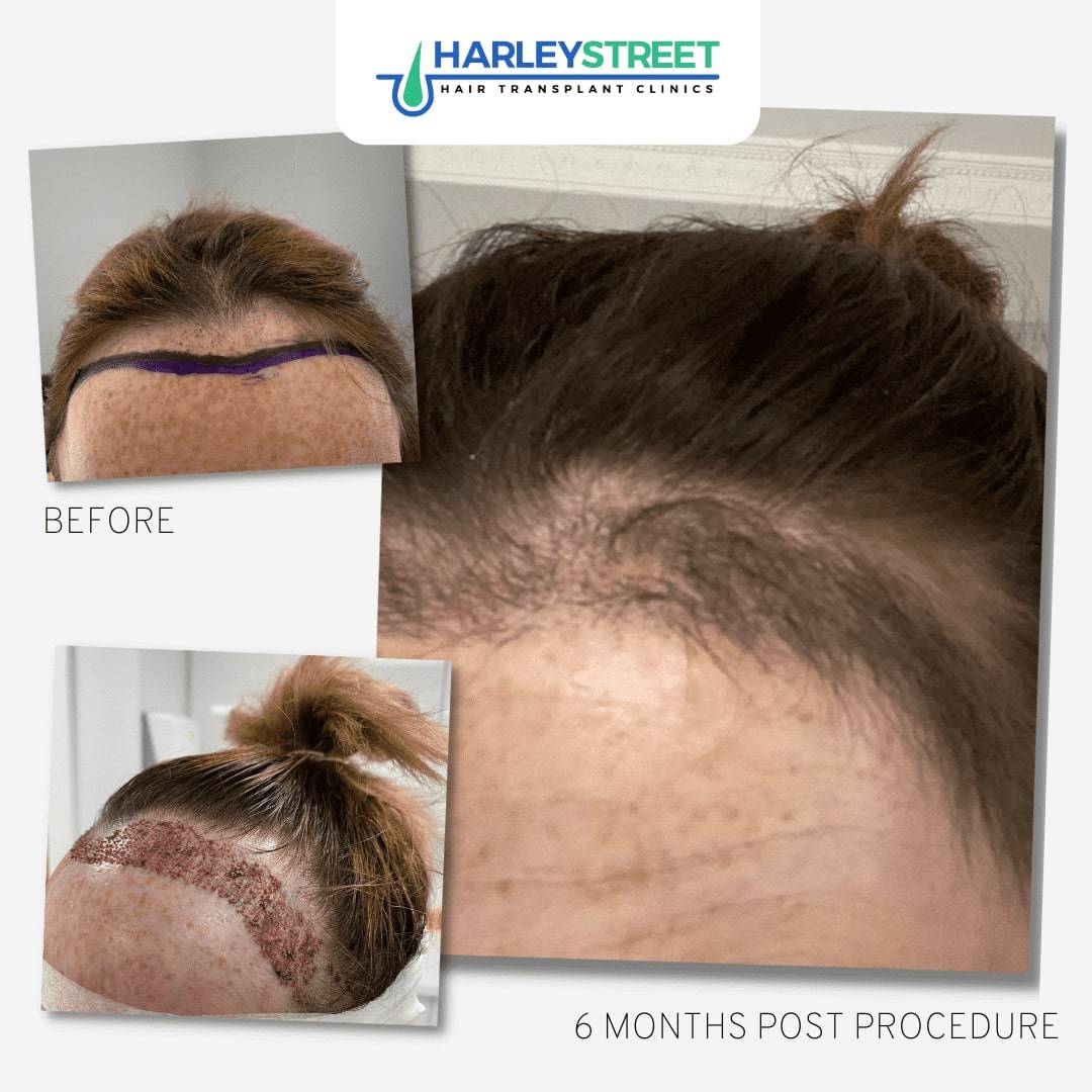 Hairline Lowering Surgery Vs Forehead Reduction FUE-Female-Hair-Transplant-Before-and-After-hairline-lowering