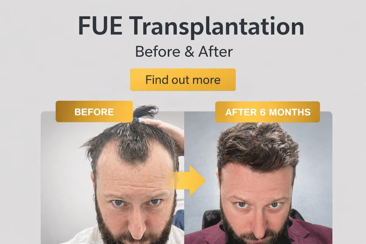 FUE Hair Transplantation