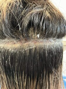 FUT hair transplant donor area