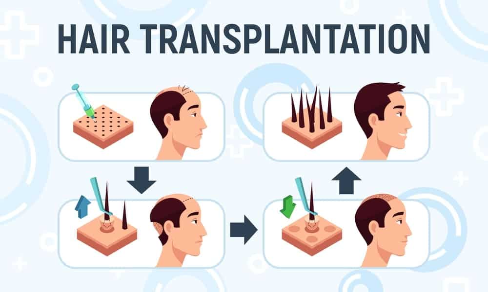 Hair Transplant Statistics Hair Transplantation statistics