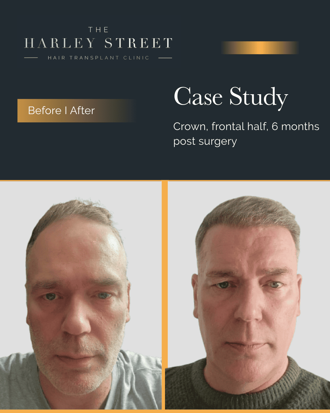 Harley Street HT Clinics pt, Mark hairline