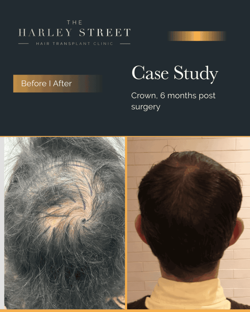 Free Consultation Harley Street HT Patient, Arturo, crown