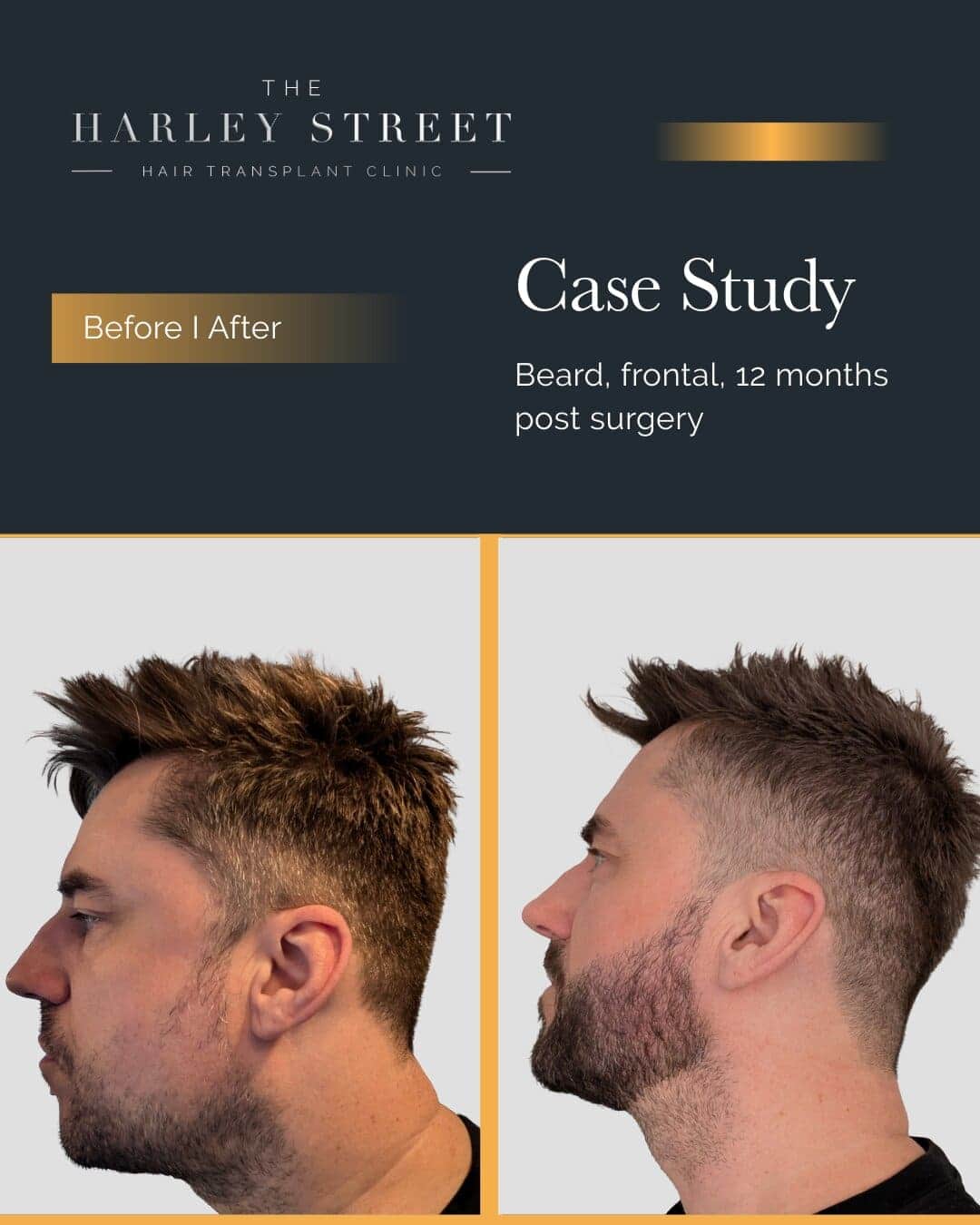 Harley Street HT Patient Beard - P Burley side