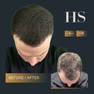Harley Street HT Pt before and after 1