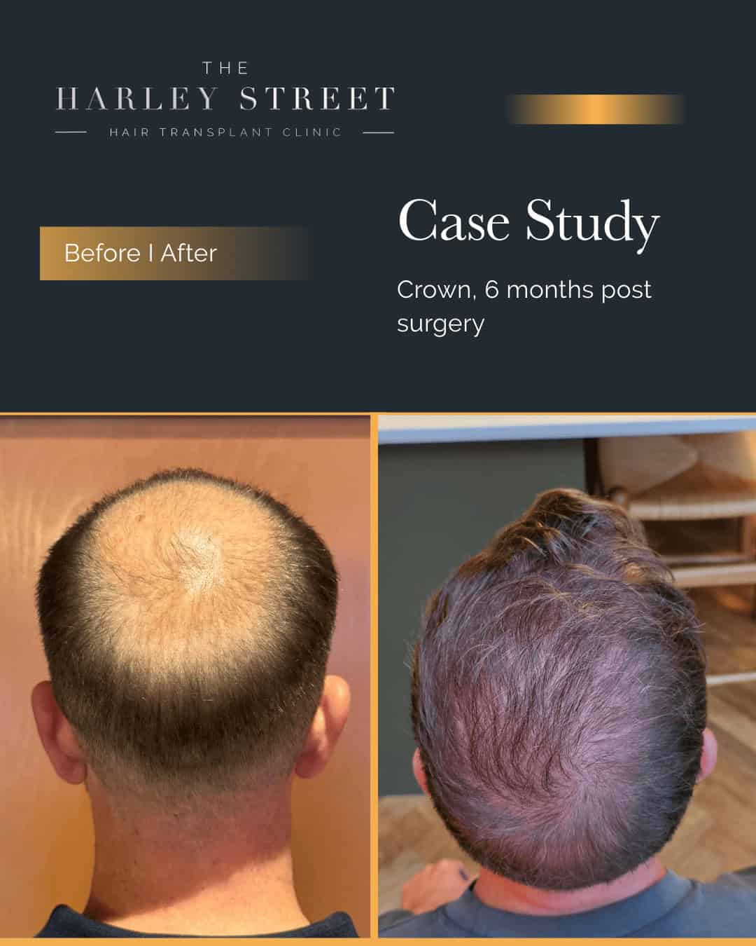 Hair Transplant Aftercare Harley Street HT clinics pt, AS crown large