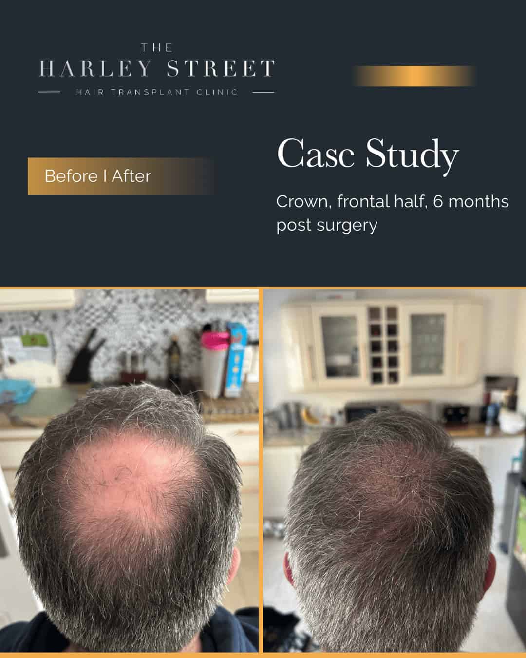 Harley Street HT clinics pt, Chris H2 crown