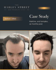 Harley Street HT patient, Elliot hairline
