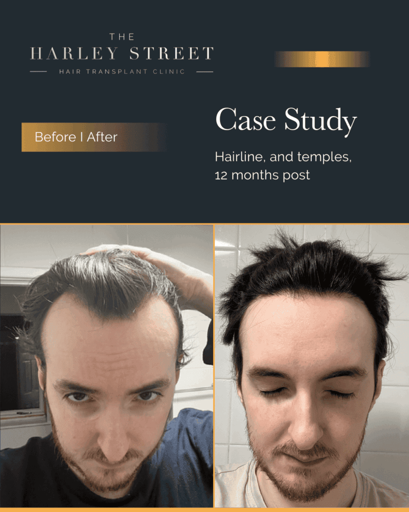 Free Consultation Harley Street HT patient, Elliot hairline
