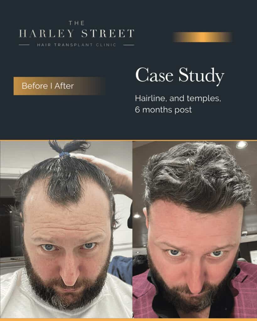 Free Consultation Harley Street HT pt Gerard Walsh hairline