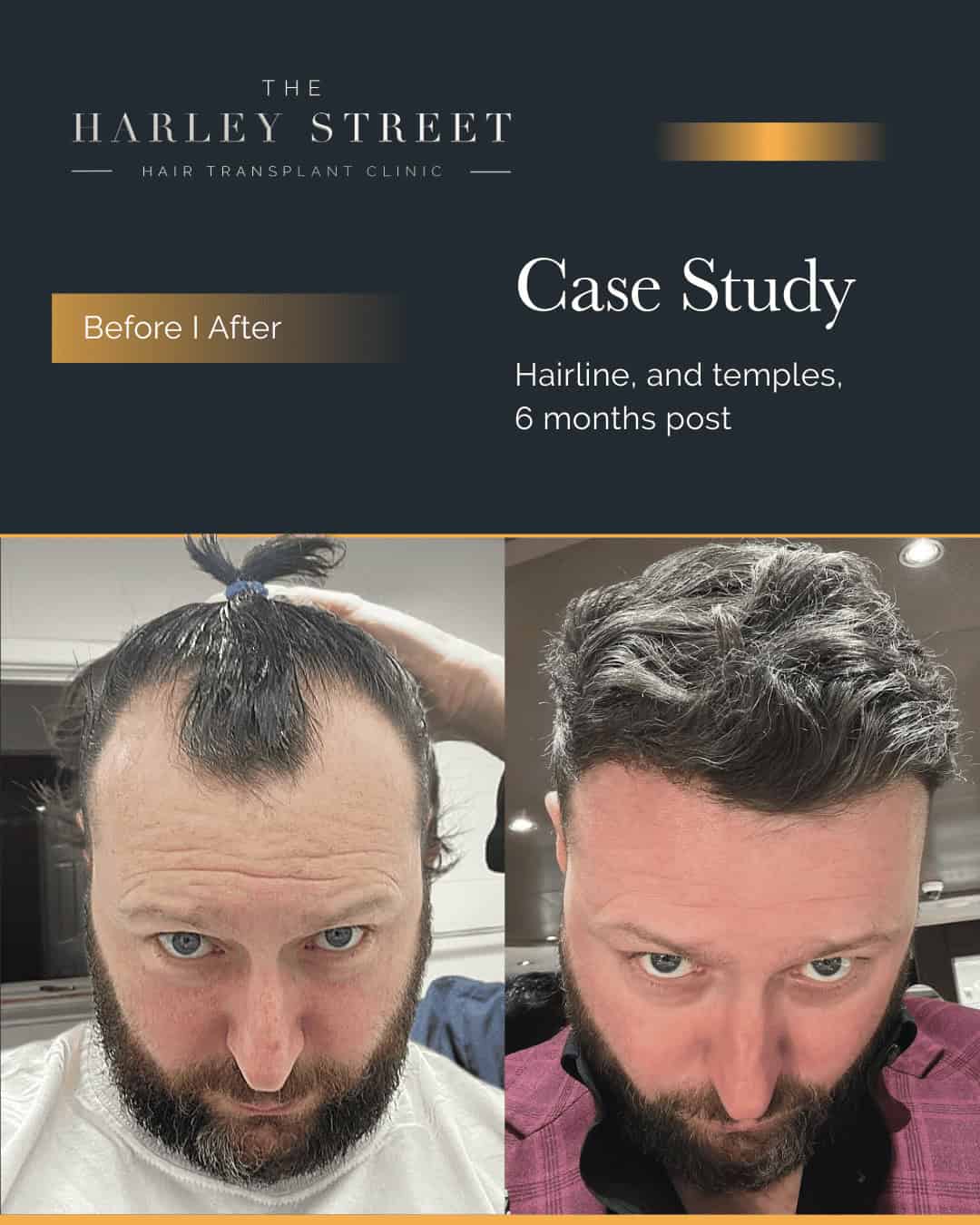 Hair Transplant Bristol Harley Street HT pt Gerard Walsh hairline