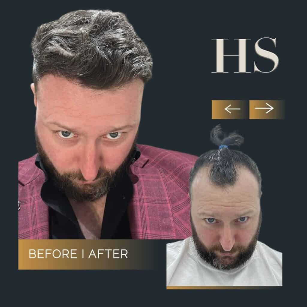 Harley Street HT pt Gerard before and after
