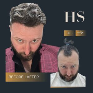Harley Street HT pt Gerard before and after