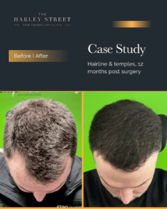 Harley Street HT pt Gill hairline