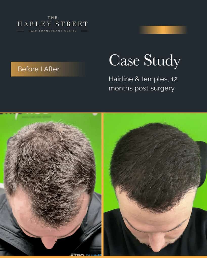 Free Consultation Harley Street HT pt Gill hairline