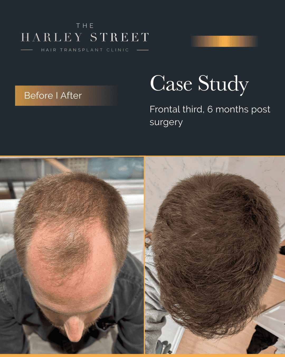 Hair Transplant Timeline Harley Street HT pt Hughes, hairline aerial view