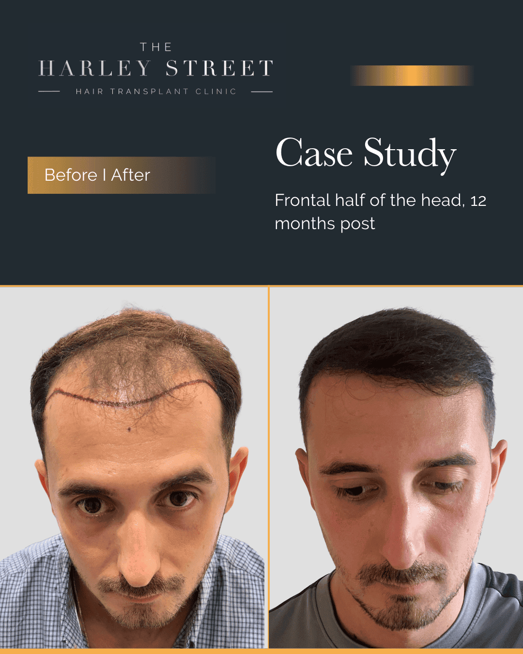 Hair Transplant Aftercare Harley Street HT pt Ilir frontal 3rd