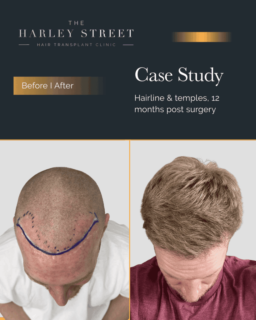 Free Consultation Harley Street HT pt Kirkpatrick hairline aerial
