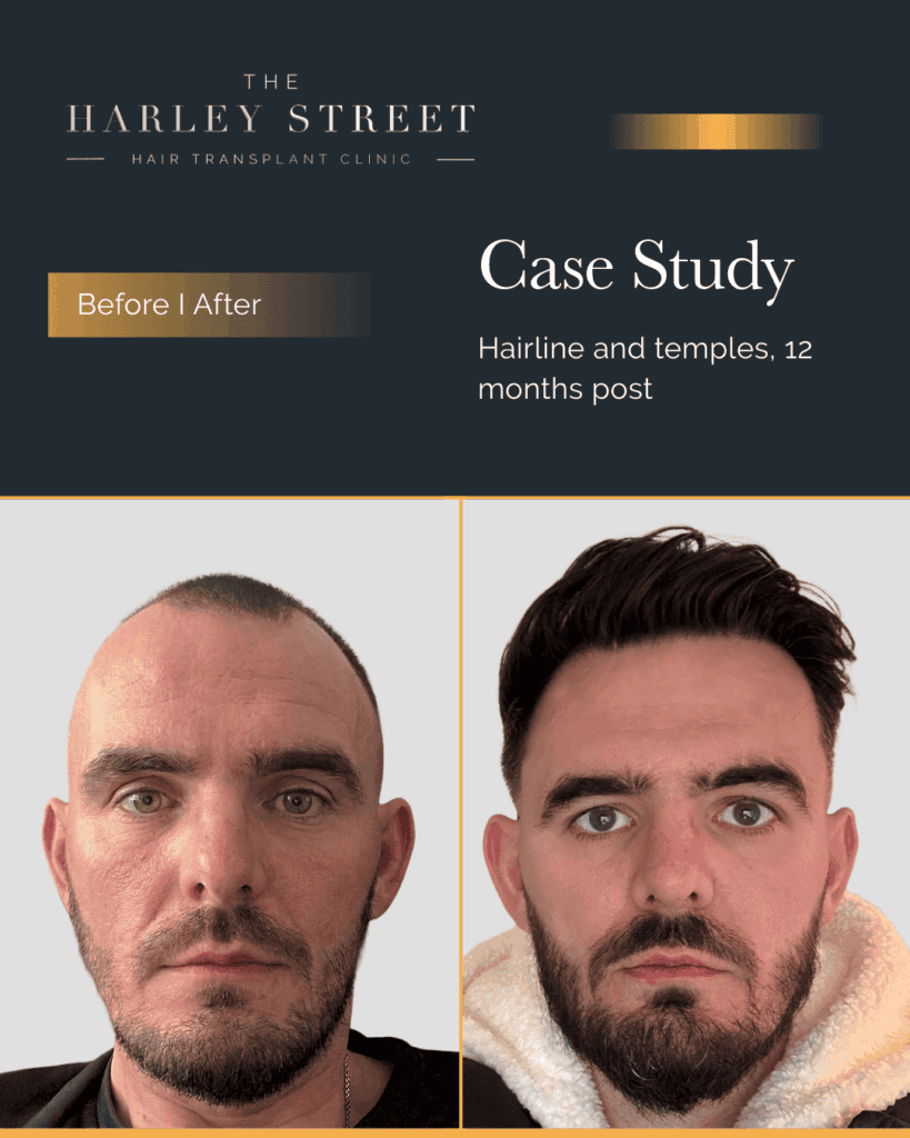 Free Consultation Harley Street HT pt Ryan frontal 3rd hairline