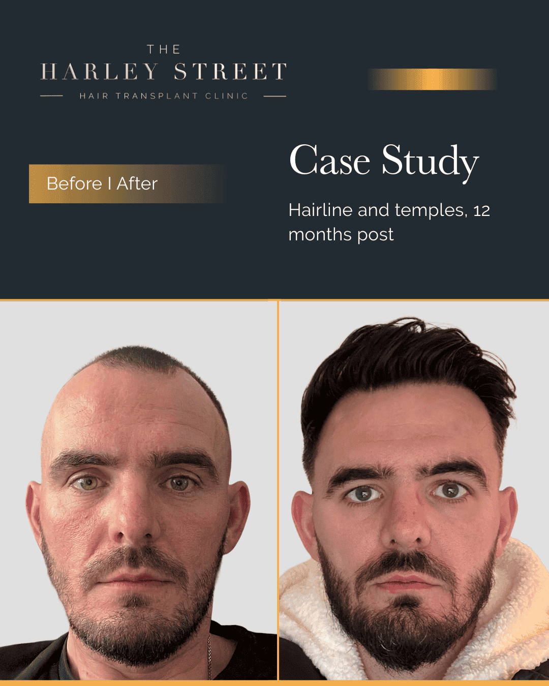 Hair Transplant Bristol Harley Street HT pt Ryan frontal 3rd hairline