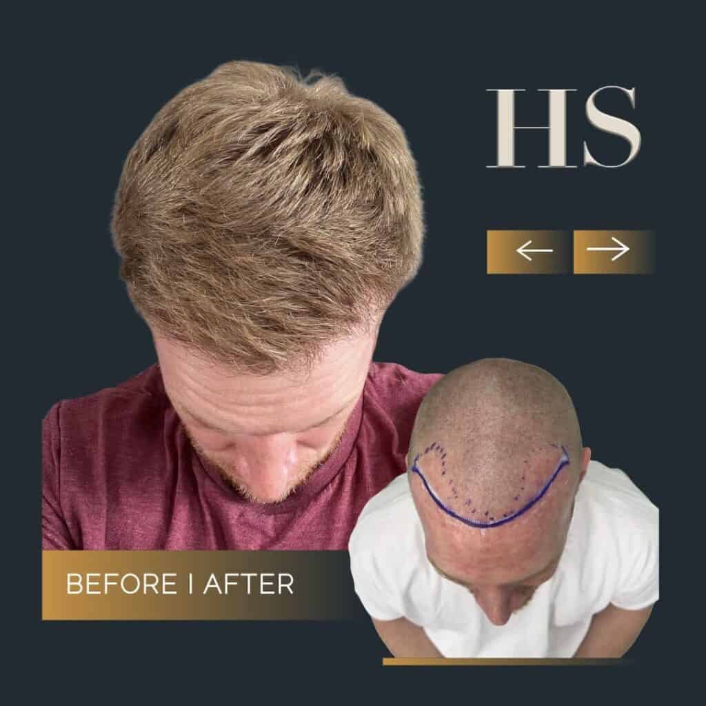 Harley Street HT pt alastair before and after