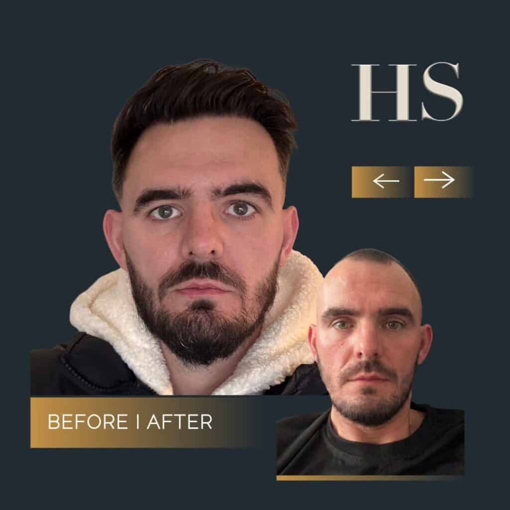 Harley Street HT pt before and after 2