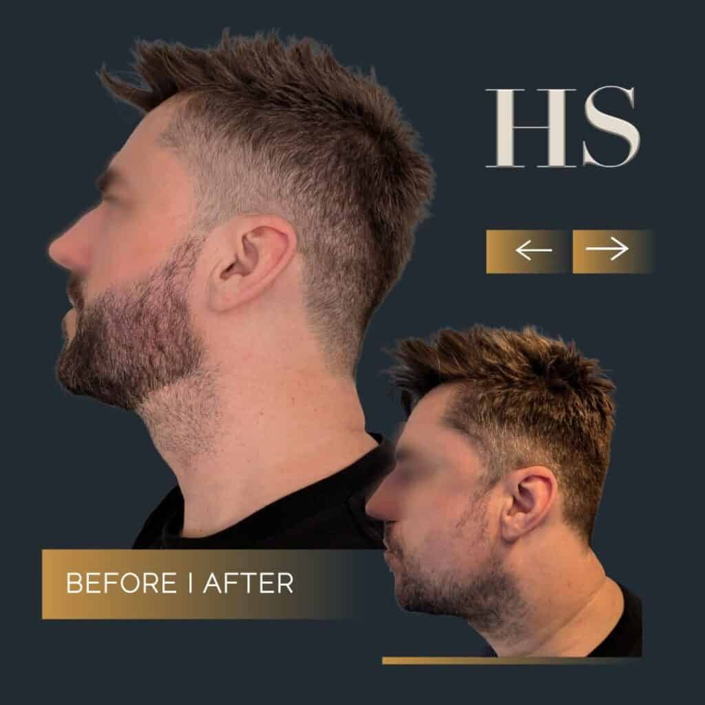 Harley Street HT pt paul beard before and after