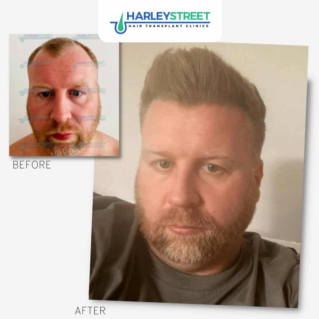 Home page SB 1 Harley Street Hair Transplant Clinics patient Aaron before and after