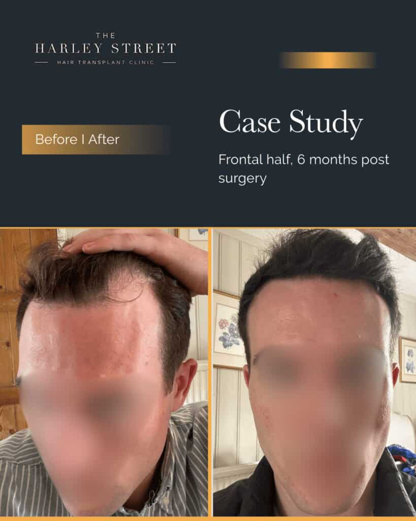 Free Consultation Harley Street pt Finney hairline