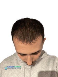 Hair Transplant Timeline Ilir 3 months post ht