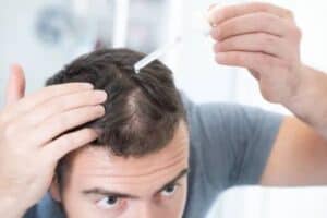 Topical Finasteride for Hair Loss Man applying topical finasteride and minoxidil combo