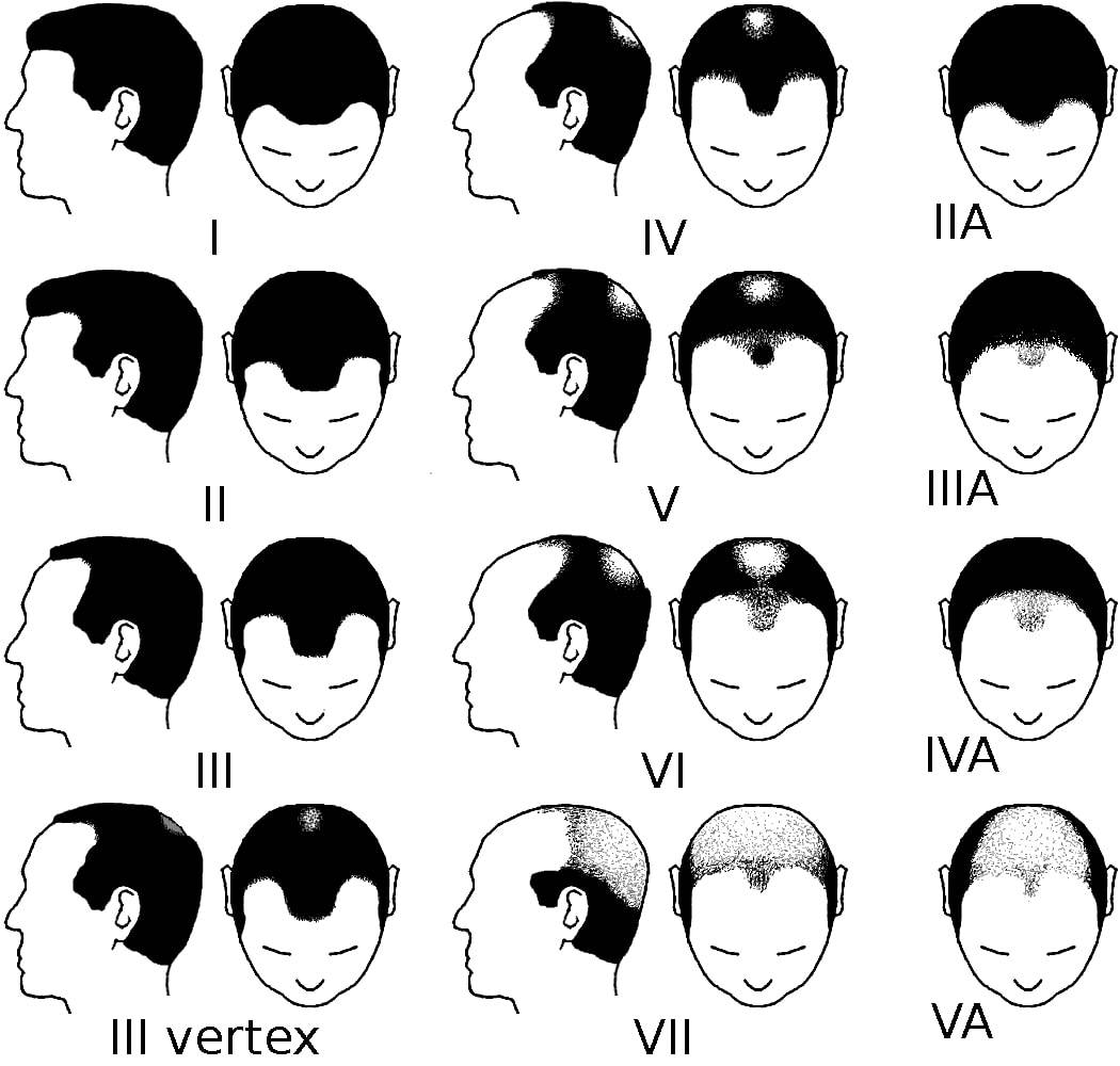 The Norwood Scale Norwood scale for male pattern baldness