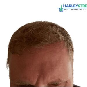 Paul_Parker_12_months_after_ht