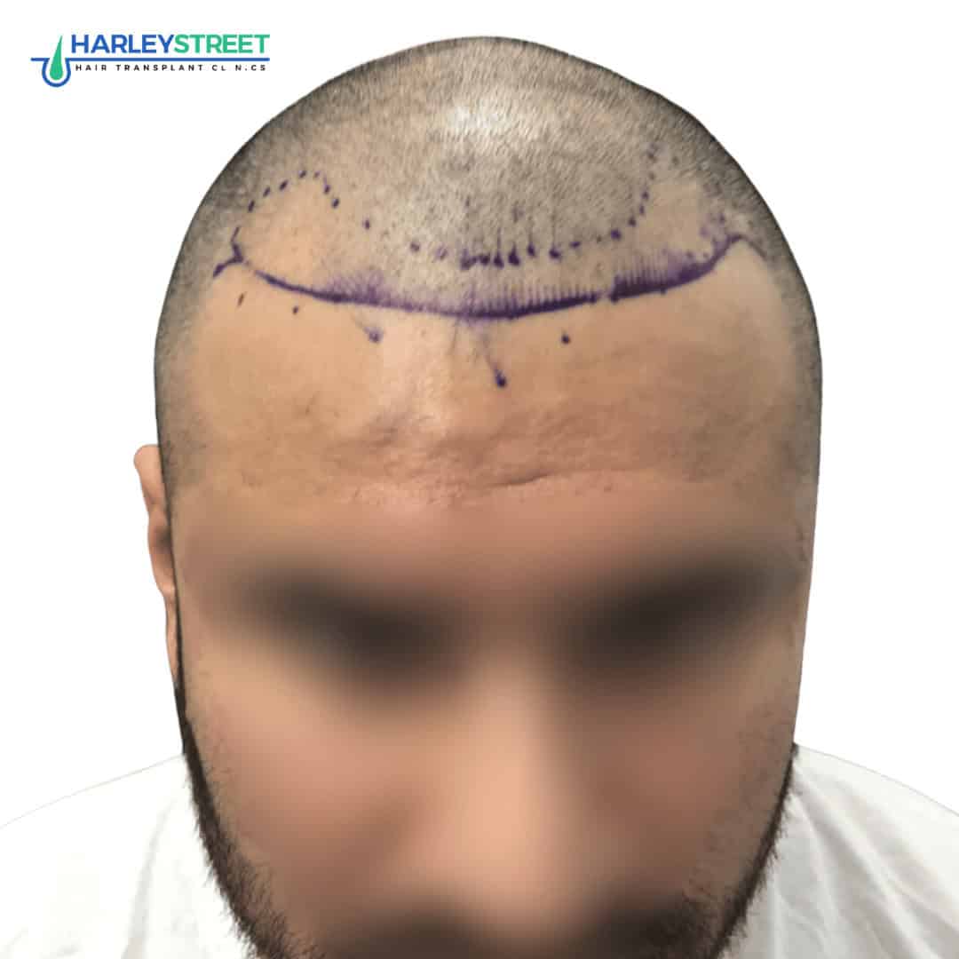 Shreyas Malhotra Pre surgery